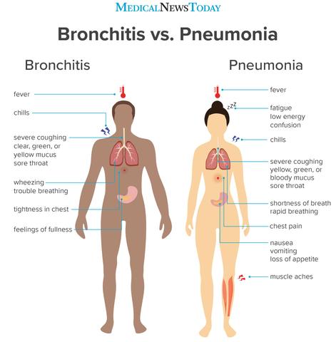 Duration of Symptoms in Viral Bronchitis